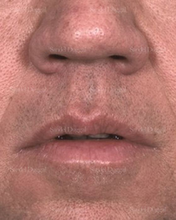 Botox & Fillers before, case 2591