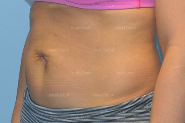 Umbilicoplasty after, case 1457
