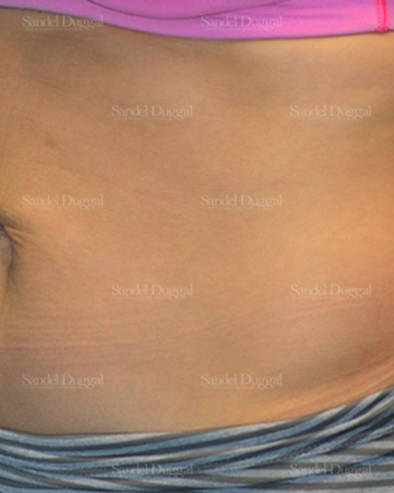 Umbilicoplasty after, case 1457