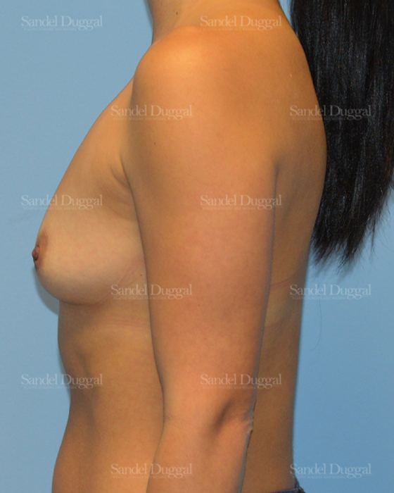 Breast Augmentation before, case 3234