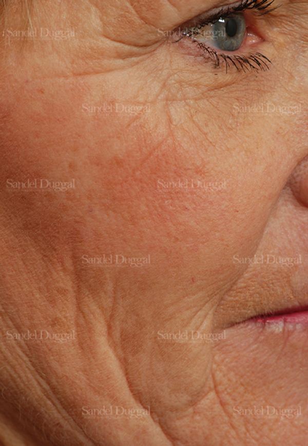 Laser Skin Resurfacing before, case 2972