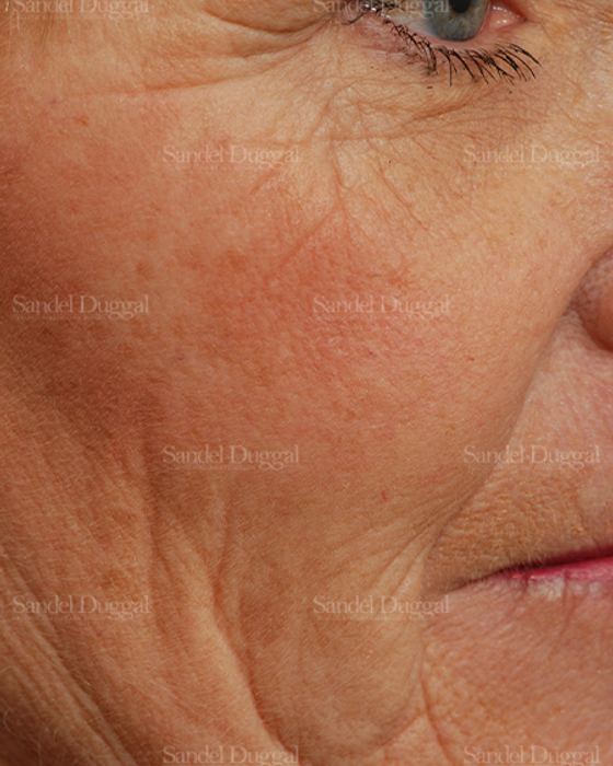 Laser Skin Resurfacing before, case 2972