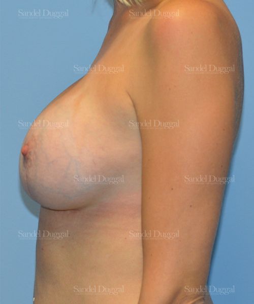 Breast Augmentation with Lift after, case 3358