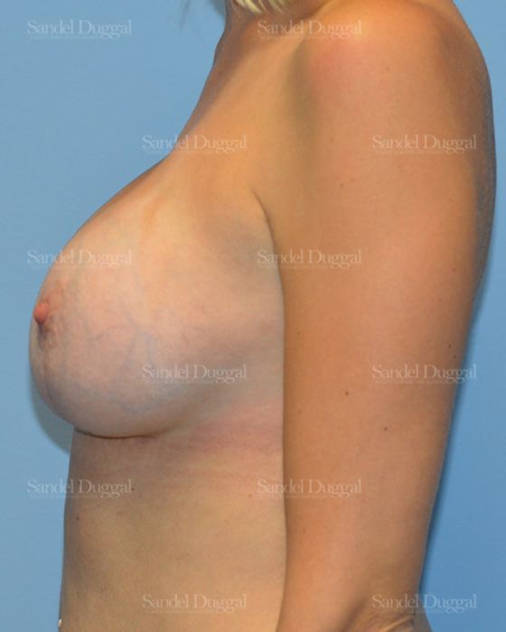 Breast Augmentation with Lift after, case 3358