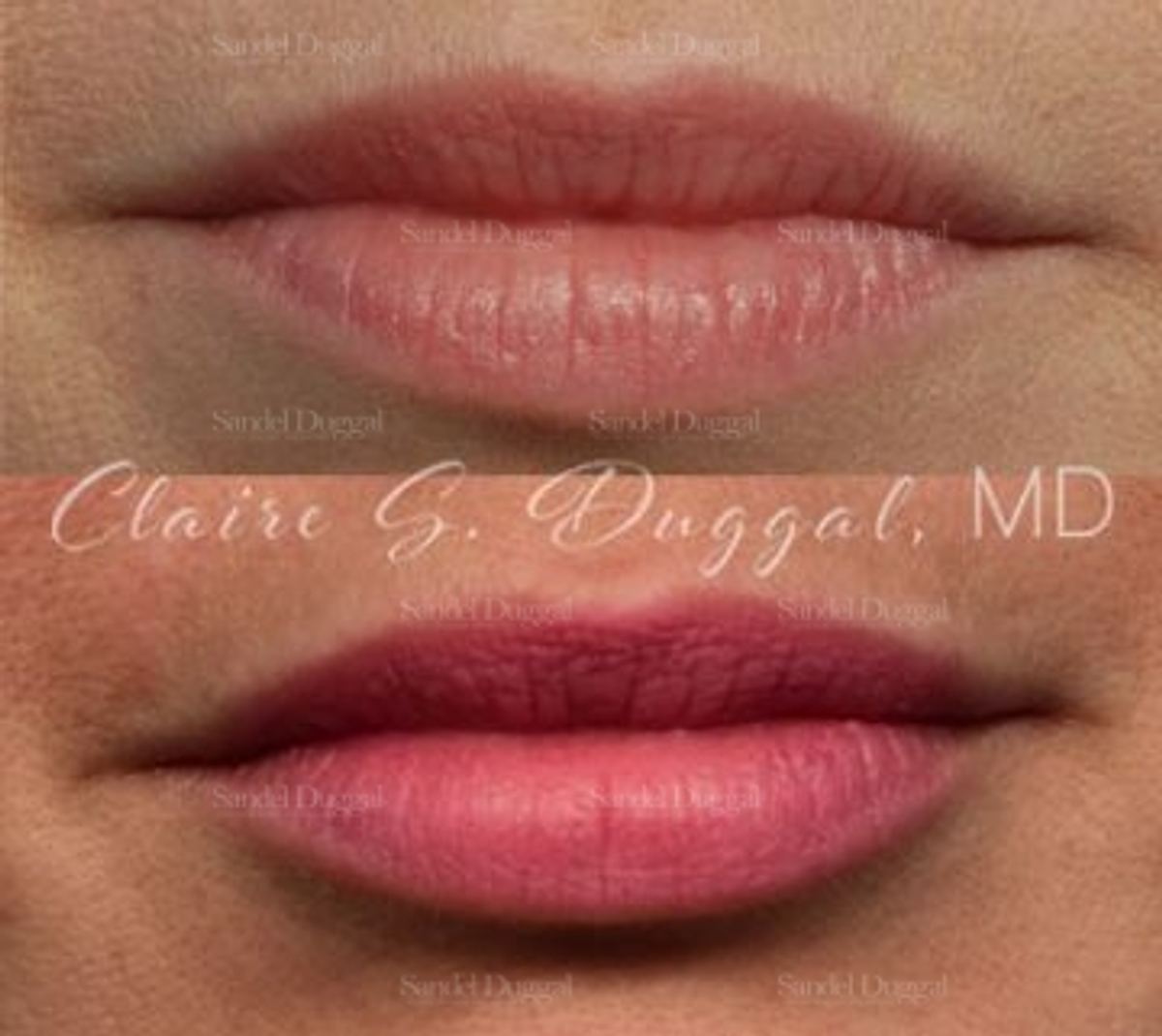 Lip Augmentation / Lip Lift before and after, case 4363