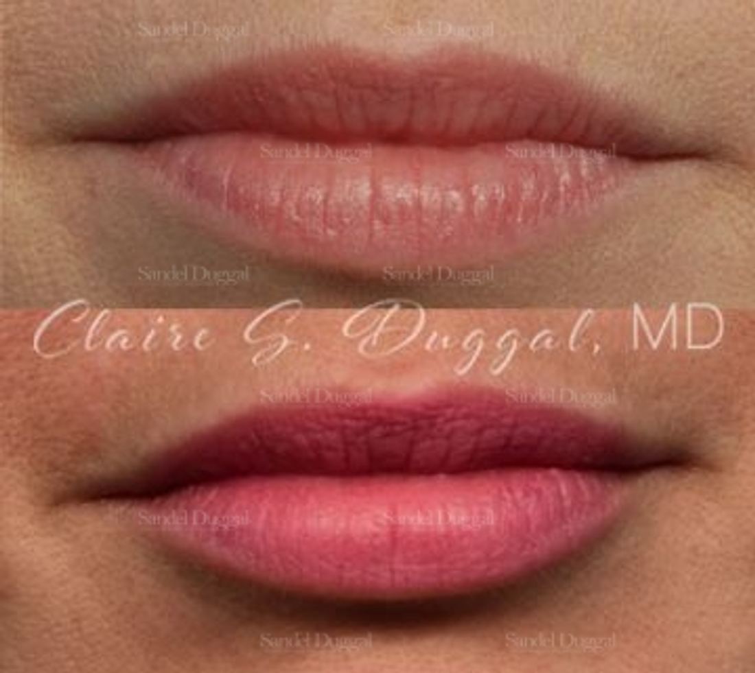 Lip Augmentation / Lip Lift before and after, case 4363