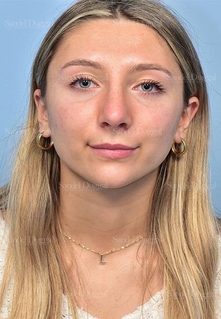 Rhinoplasty after, case 5375