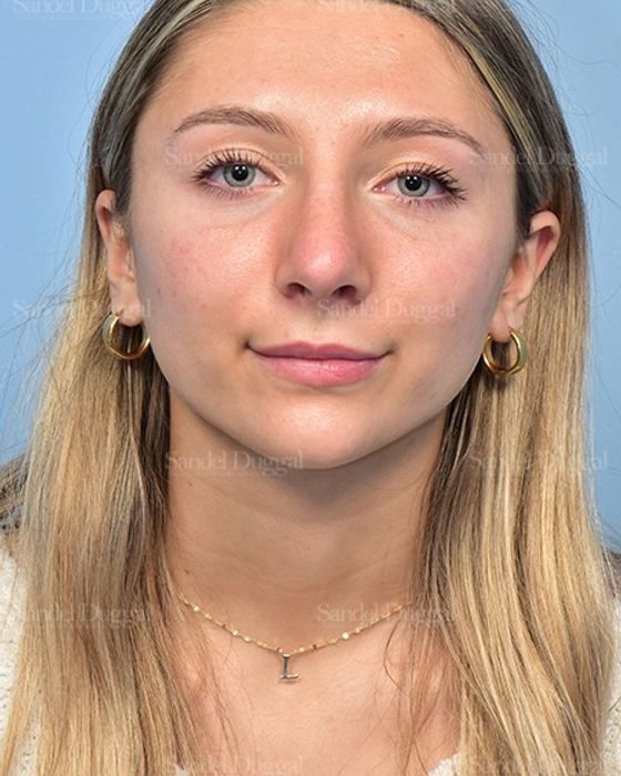 Rhinoplasty after, case 5375