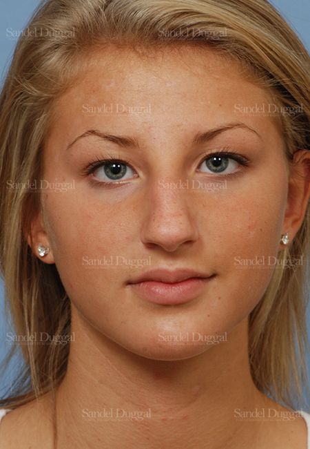 Rhinoplasty before, case 2876