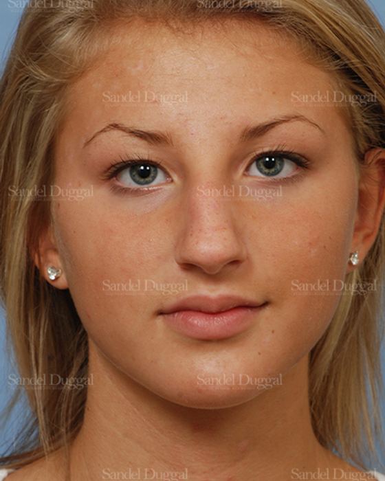 Rhinoplasty before, case 2876