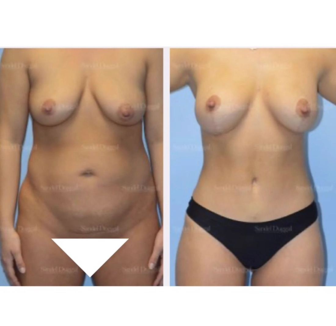 Mommy Makeover before and after, case mommy-makeover-11