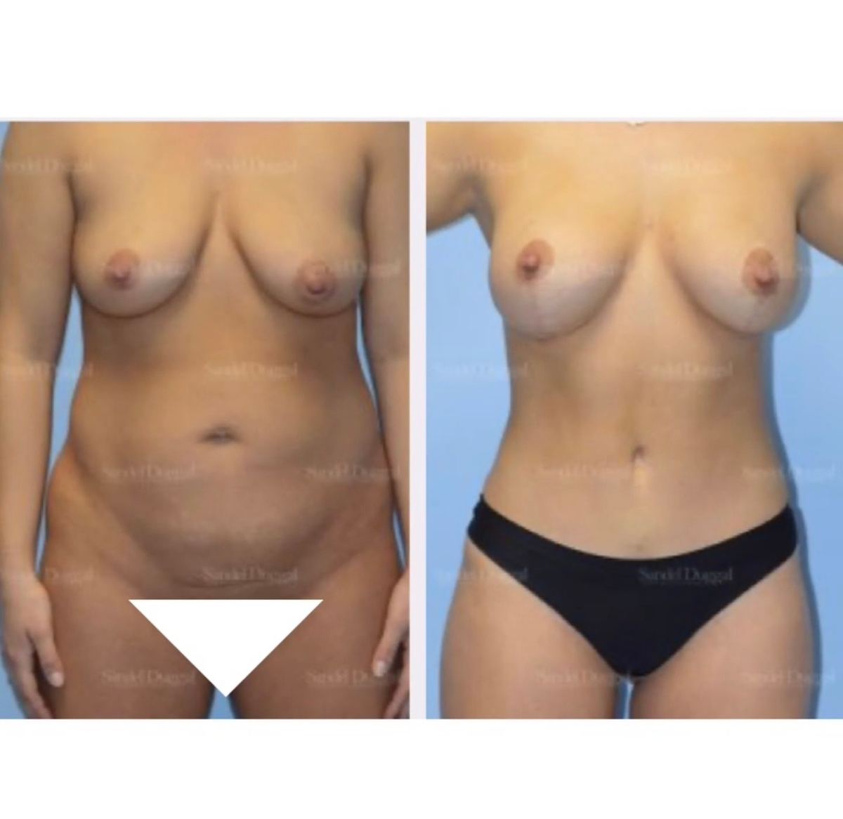 Mommy Makeover before and after