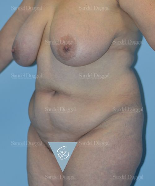 Tummy Tuck before, case 1533