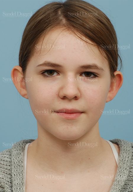 Otoplasty before, case 2598