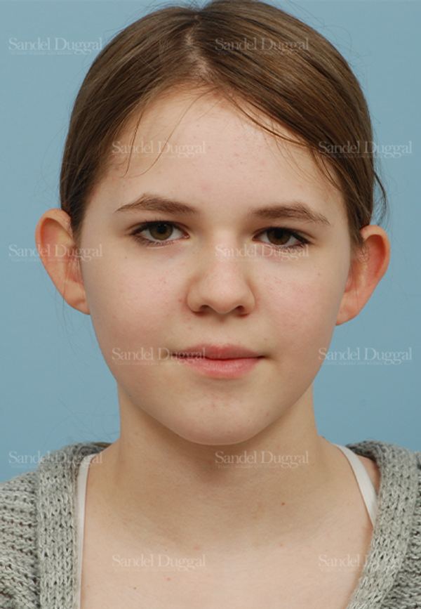 Otoplasty before, case 2598