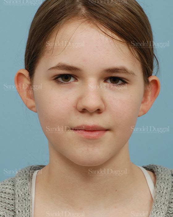 Otoplasty before, case 2598