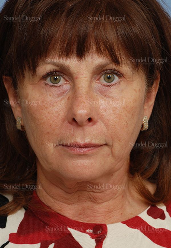 Facelift before, case 2666
