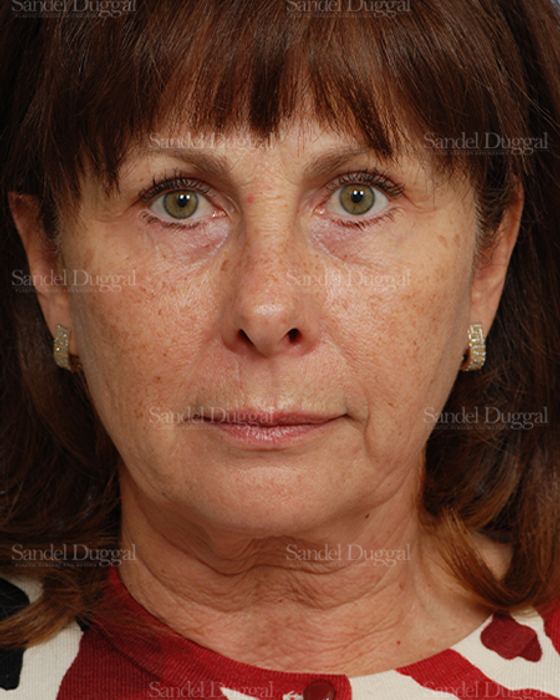 Facelift before, case 2666