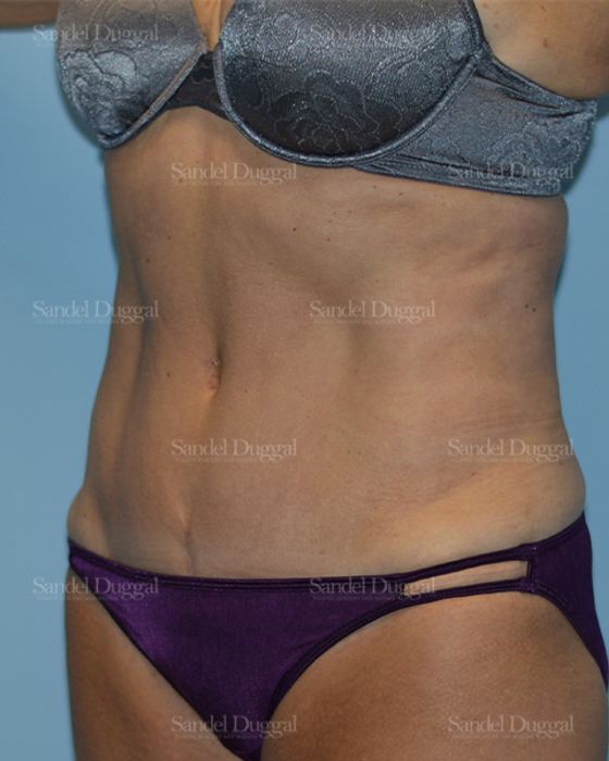 Tummy Tuck after, case 1636