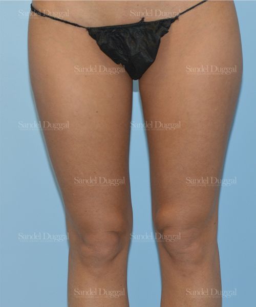 Liposuction — Legs & Flanks before, case 2540