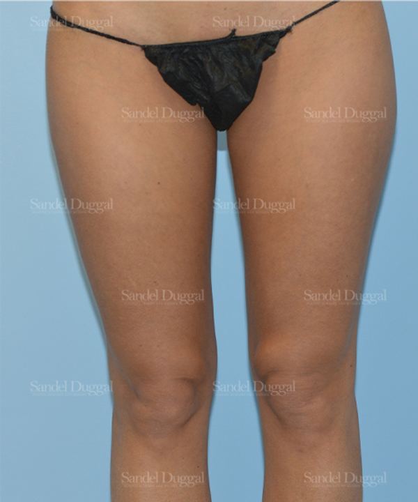 Liposuction — Legs & Flanks before, case 2540