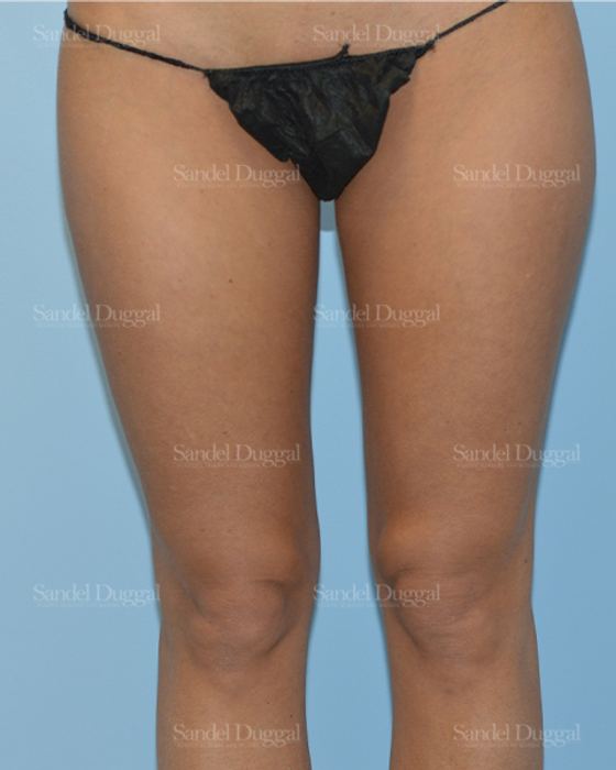 Liposuction — Legs & Flanks before, case 2540