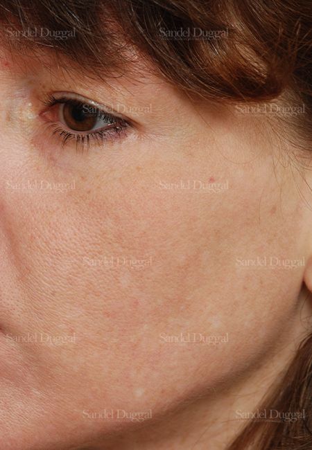 Laser Skin Resurfacing after, case 2986