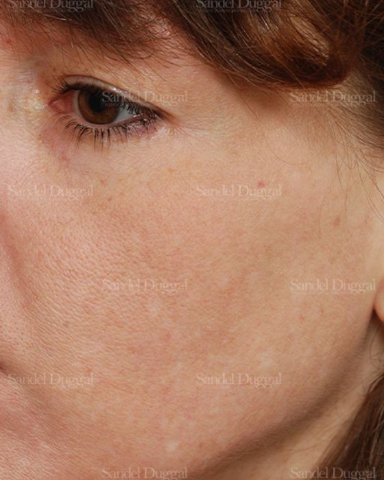 Laser Skin Resurfacing after, case 2986