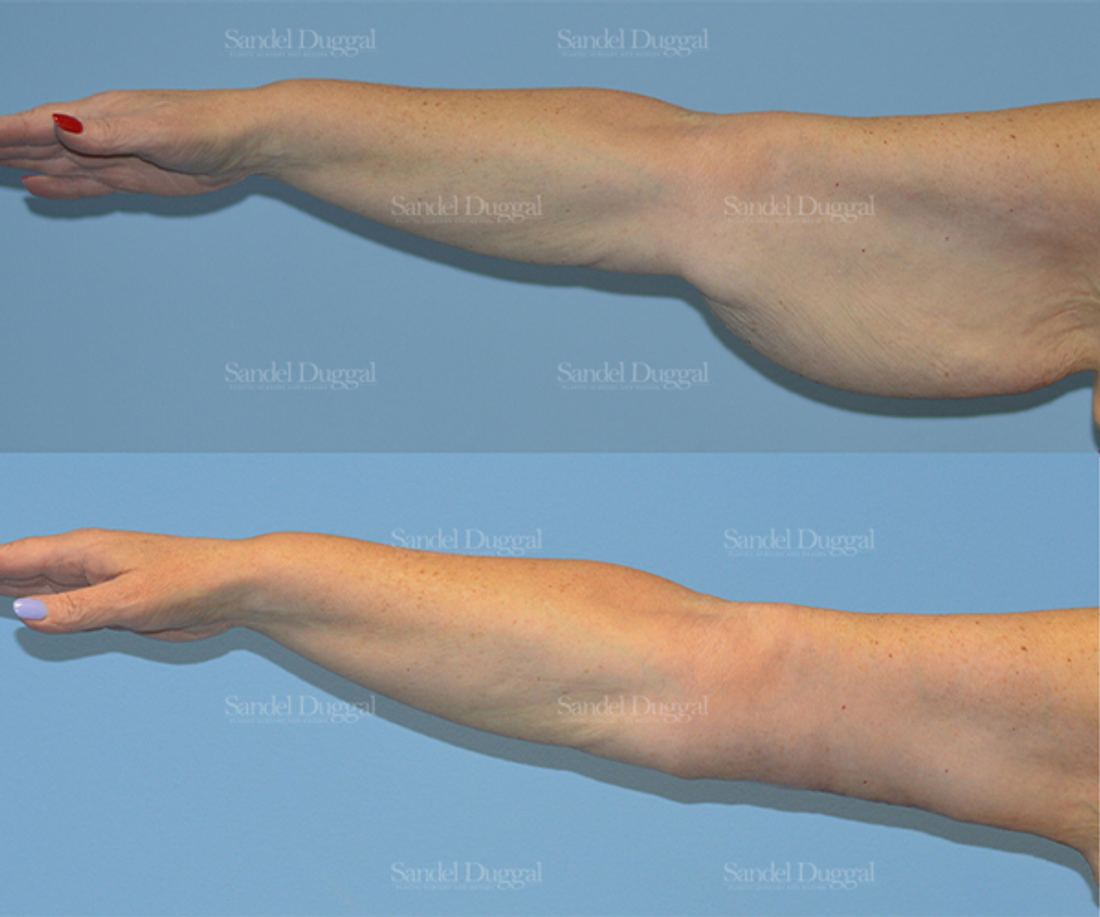 Brachioplasty before and after, case 2139