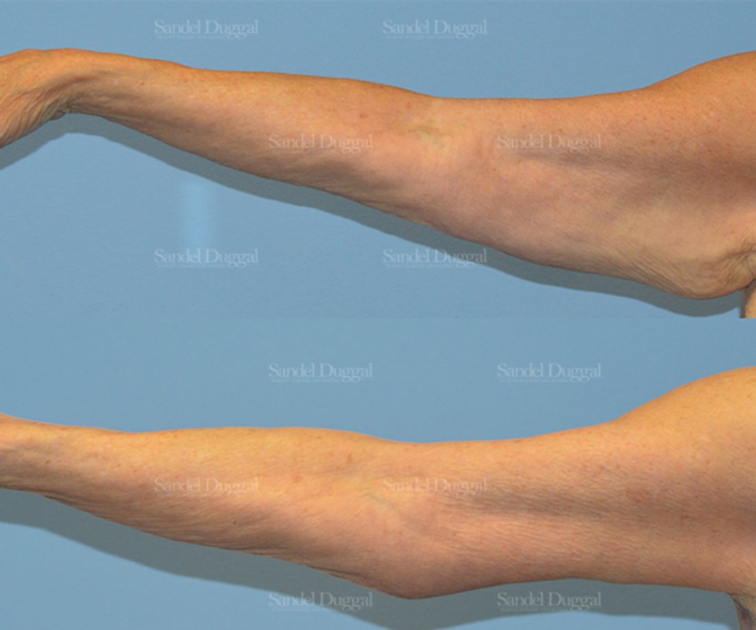 Brachioplasty before and after, case 2144