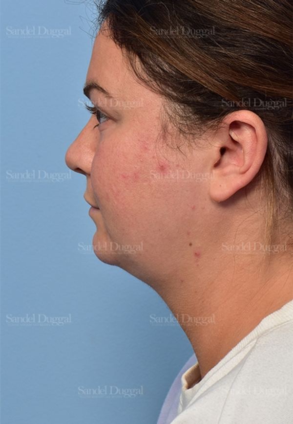Neck & Chin Liposuction before, case 5362