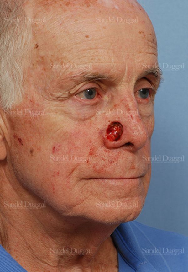 Reconstruction after Mohs before, case 2808