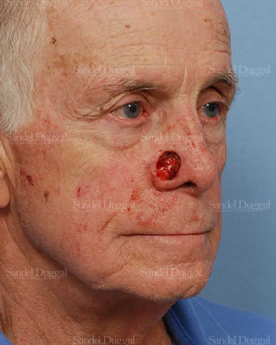 Reconstruction after Mohs before, case 2808