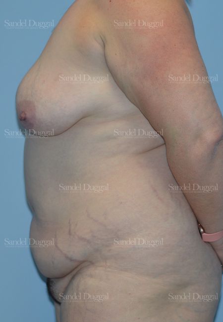 Mommy Makeover before, case 2190