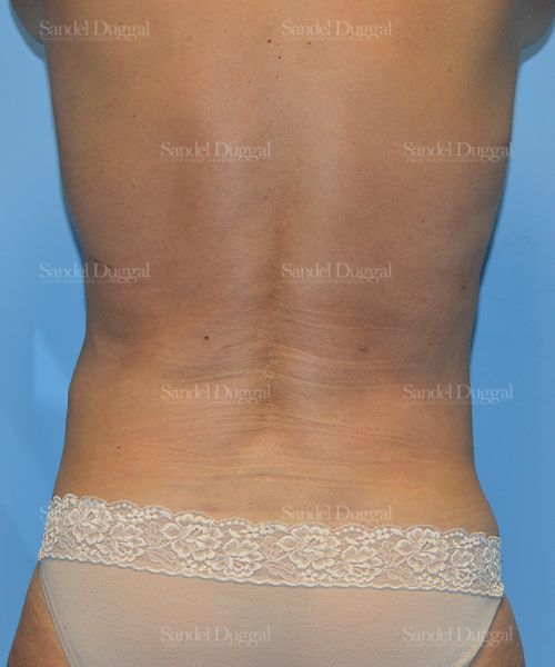 Liposuction — Legs & Flanks after, case 2501