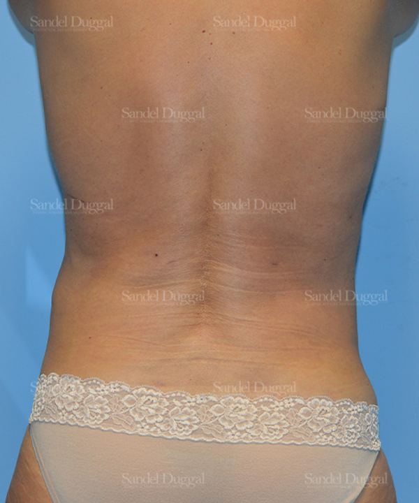 Liposuction — Legs & Flanks after, case 2501