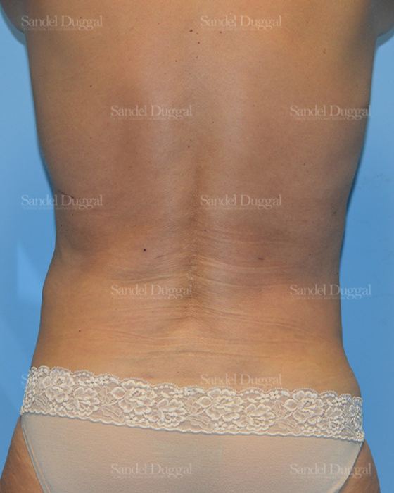 Liposuction — Legs & Flanks after, case 2501