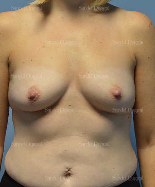 Breast Augmentation before, case 3192