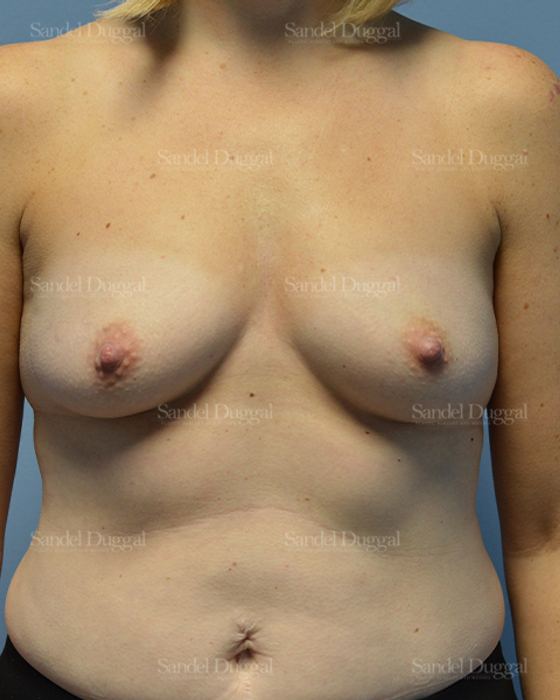 Breast Augmentation before, case 3192