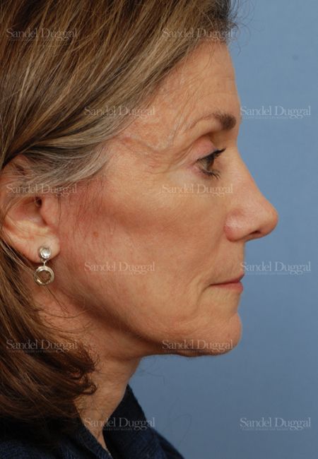 Rhinoplasty after, case 2845