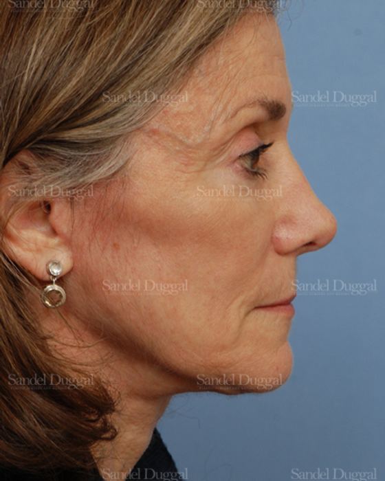 Rhinoplasty after, case 2845