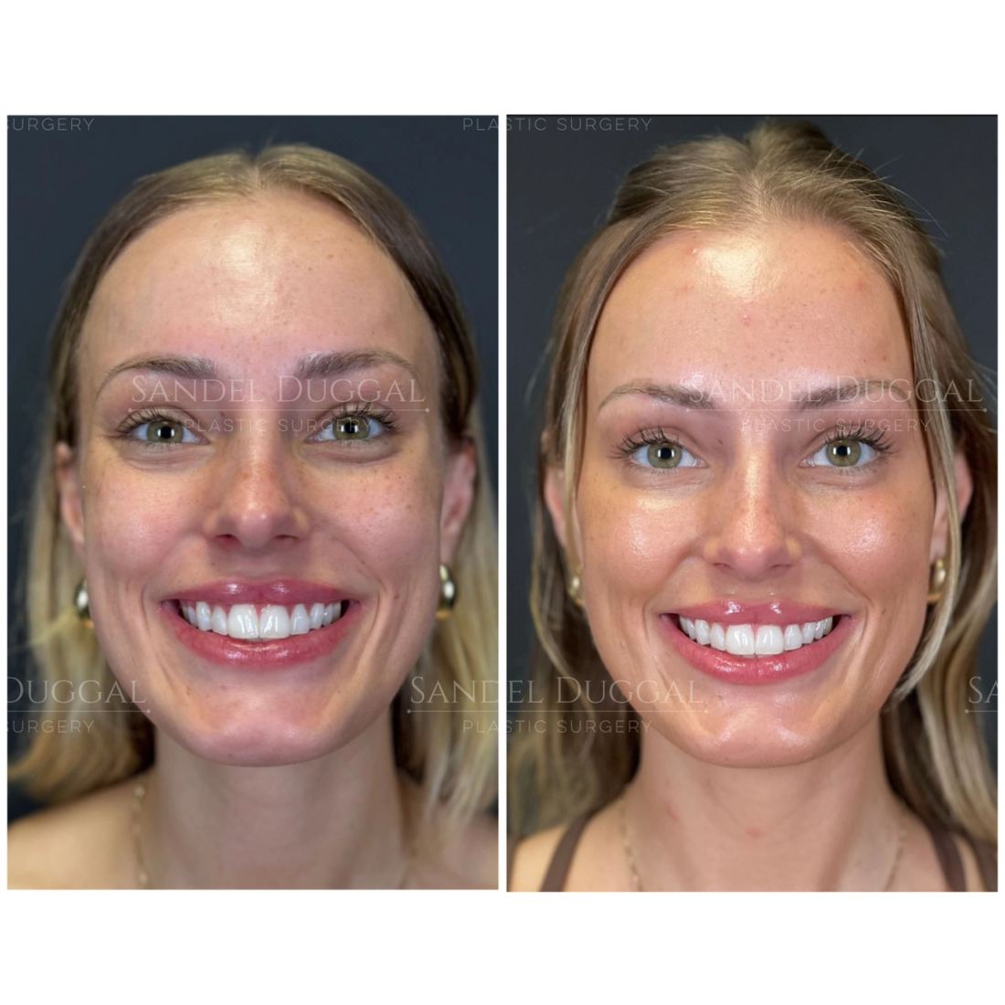 Botox & Fillers before and after, case 6012
