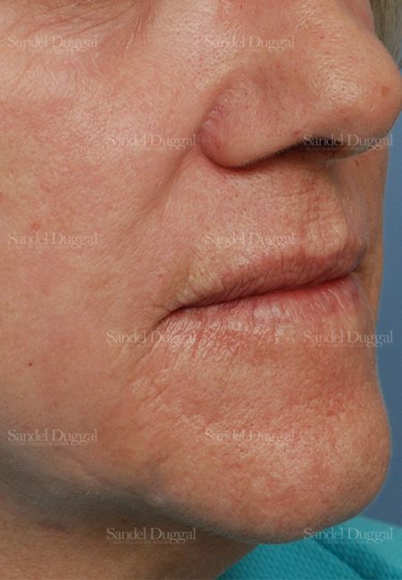 Laser Skin Resurfacing after, case 2932
