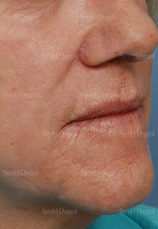 Laser Skin Resurfacing after, case 2932