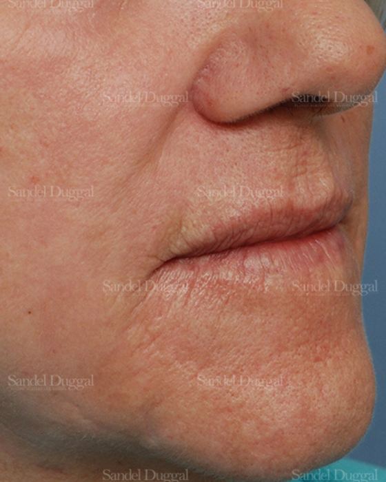 Laser Skin Resurfacing after, case 2932