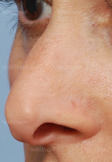 Revision Rhinoplasty before, case 2624