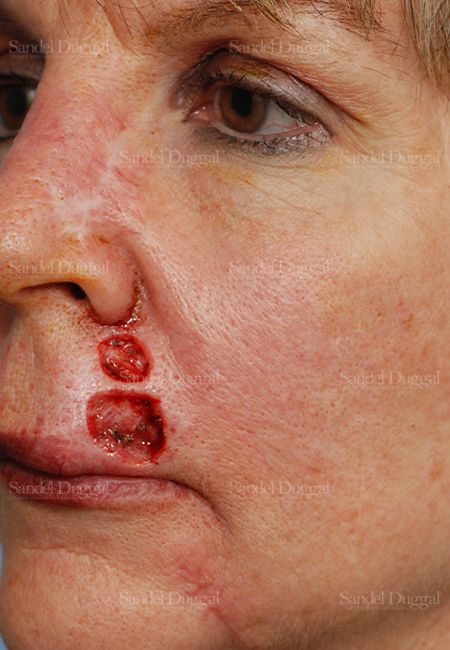 Reconstruction after Mohs before, case 2769