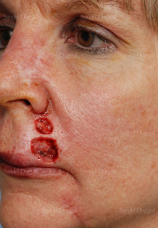 Reconstruction after Mohs before, case 2769