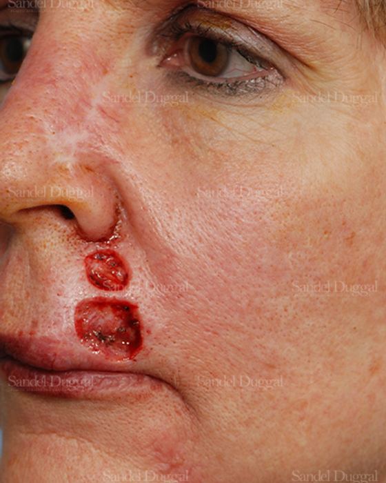 Reconstruction after Mohs before, case 2769