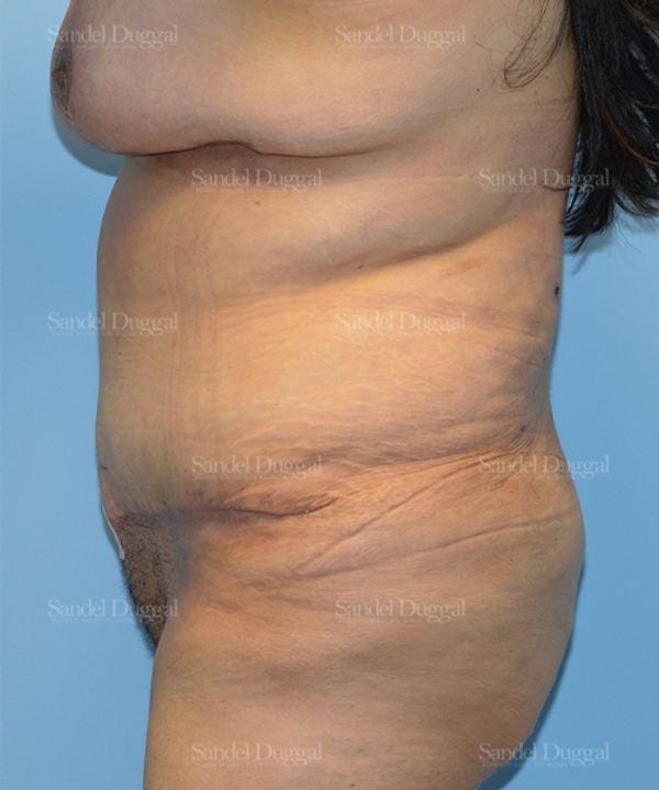 Tummy Tuck after, case 1547